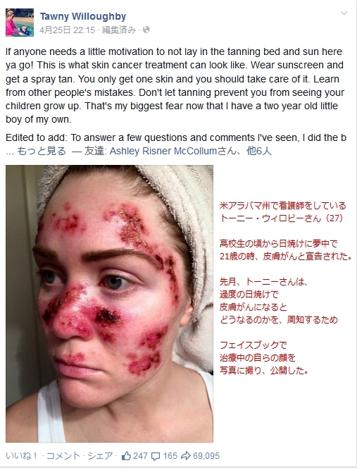 米アラバマ州で看護師をしているトーニーさん(27) 高校生の頃から日焼けに夢中で21歳の時、皮膚ガンを宣告。 過度の日焼けで皮膚ガンになるとどうなるか、周知するため、自らの顔を写真に取り、公開