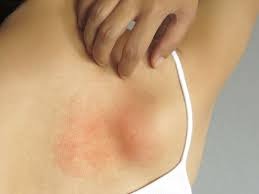 Chlorine rash.jpg