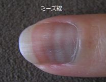 ミーズ線.jpg