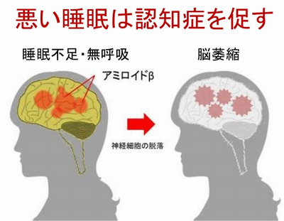 睡眠不足認知症.png
