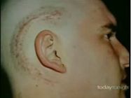 携帯電話で腫瘍ができた男性