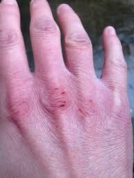 chapped hand.jpg