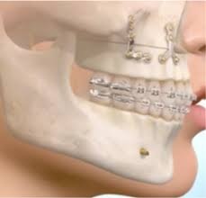 toothMetal.jpg