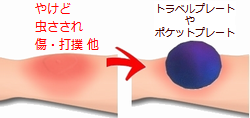 やけど虫刺されキズ、その他の患部に、テスラ トラベルプレート